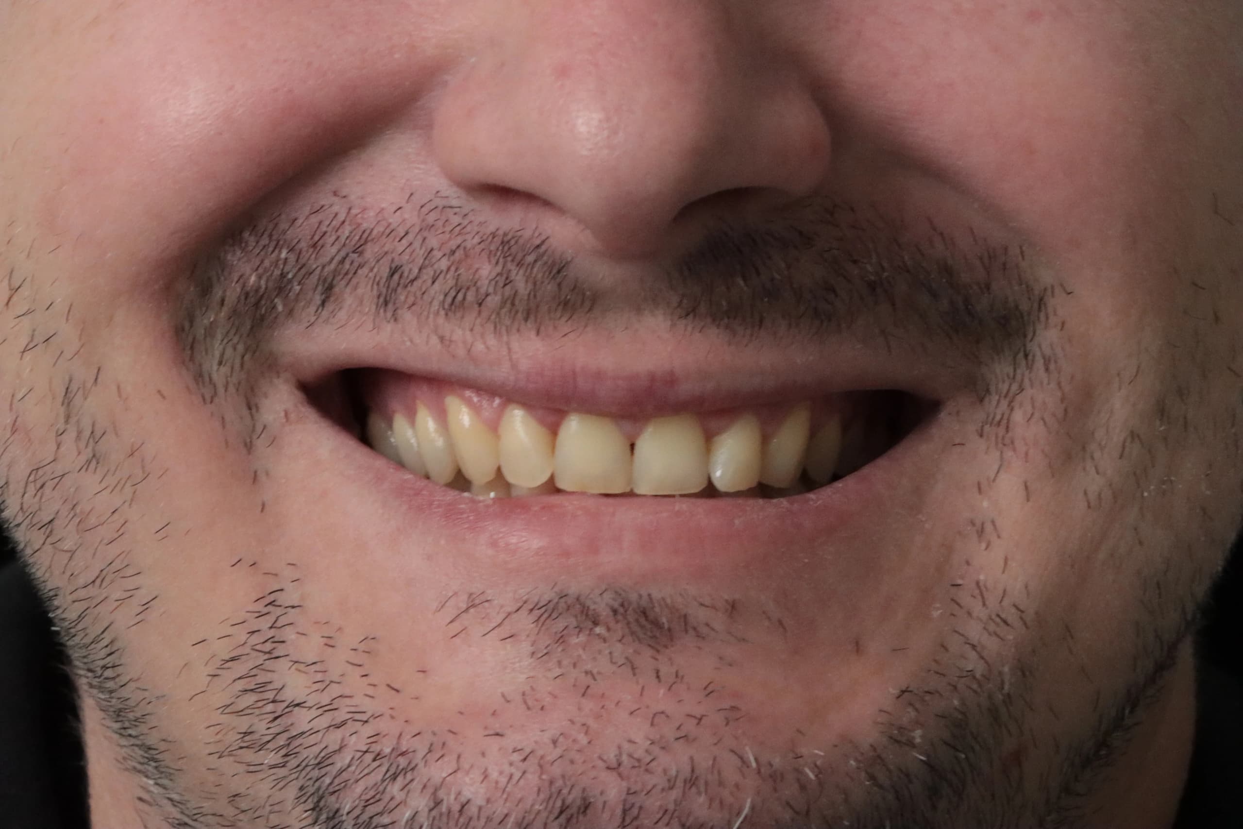 Before treatment