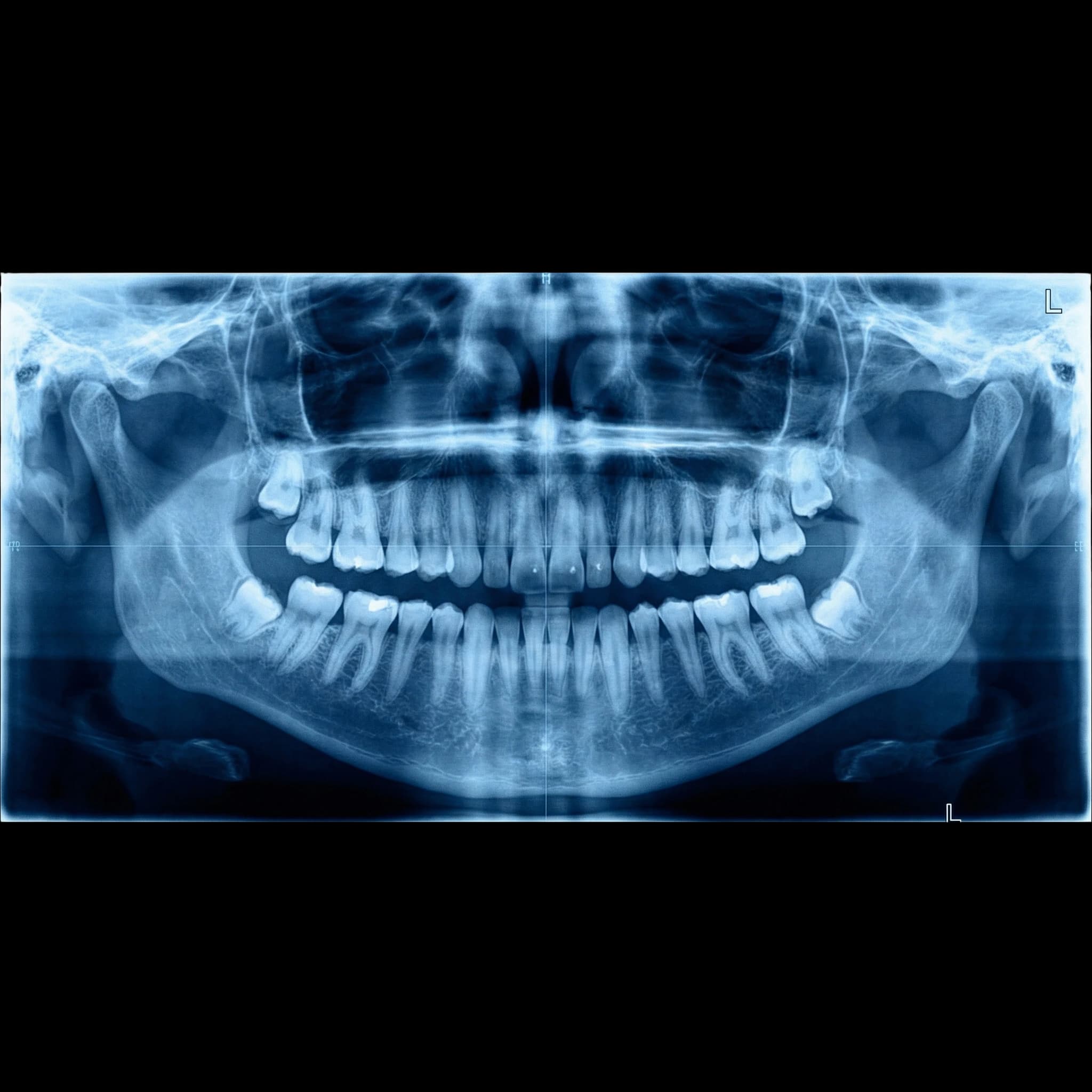 Panoramic X-Ray